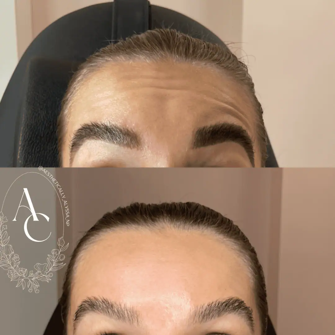Botox Services in New York | Timelyss Med Spa