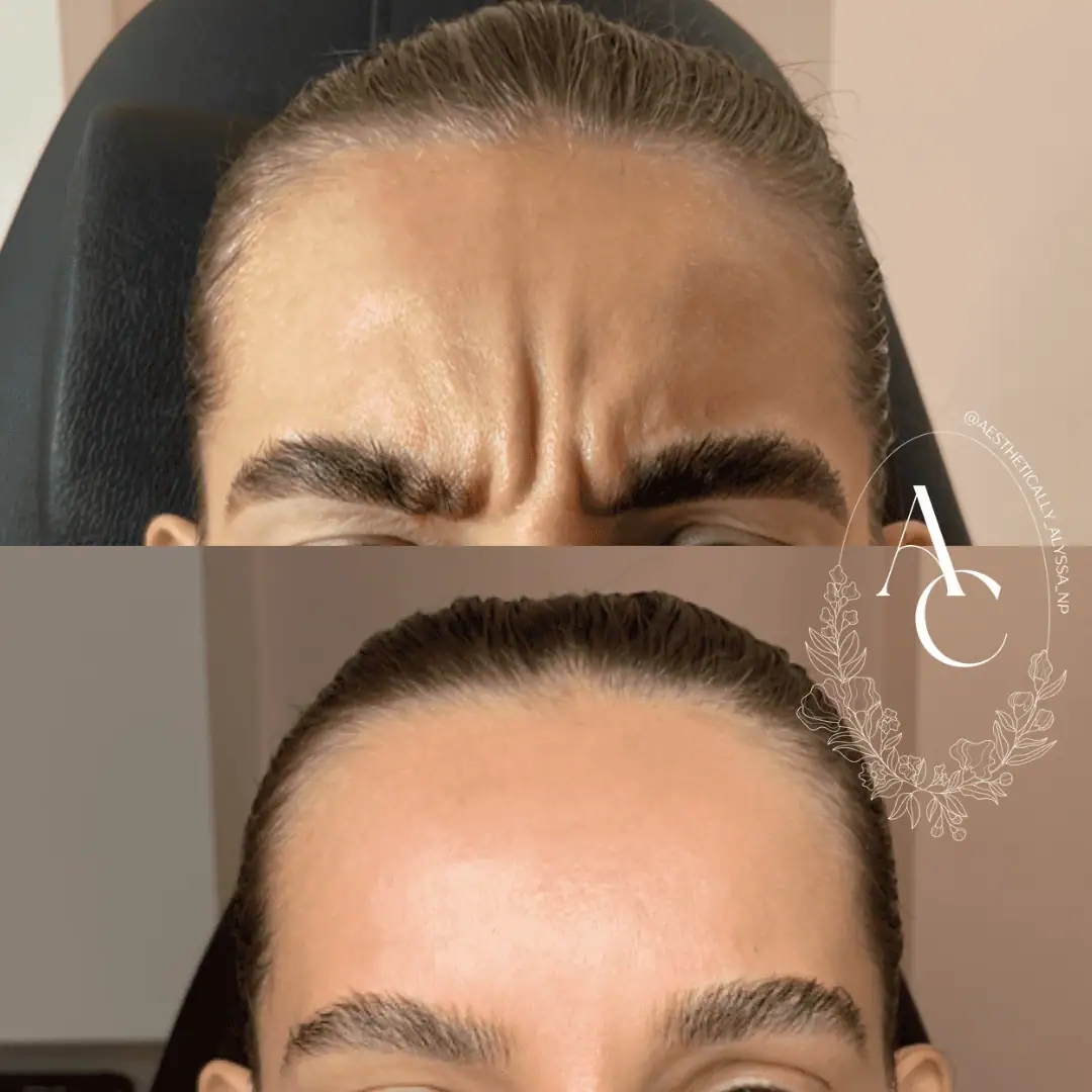 Botox Services in New York | Timelyss Med Spa