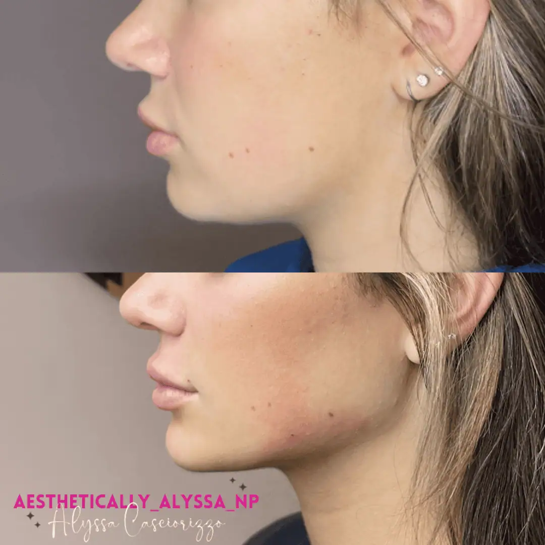 Jawline Filler in New York | Timelyss Med Spa