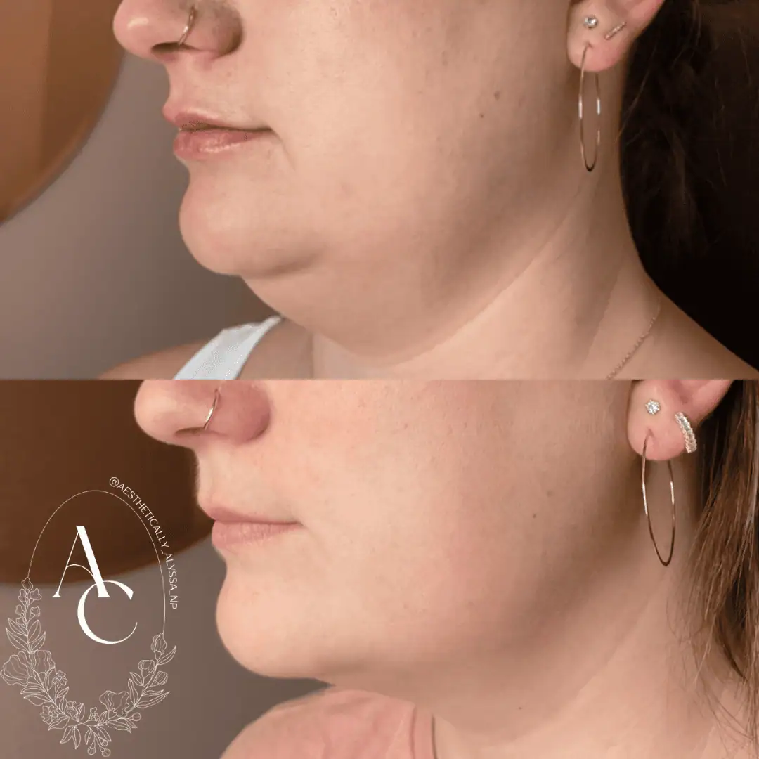 Kybella in New York | Timelyss Med Spa