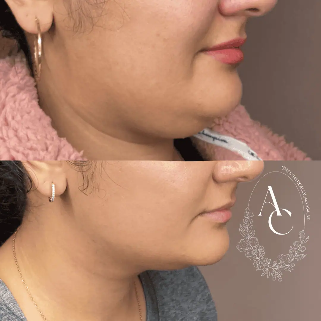 Kybella in New York | Timelyss Med Spa