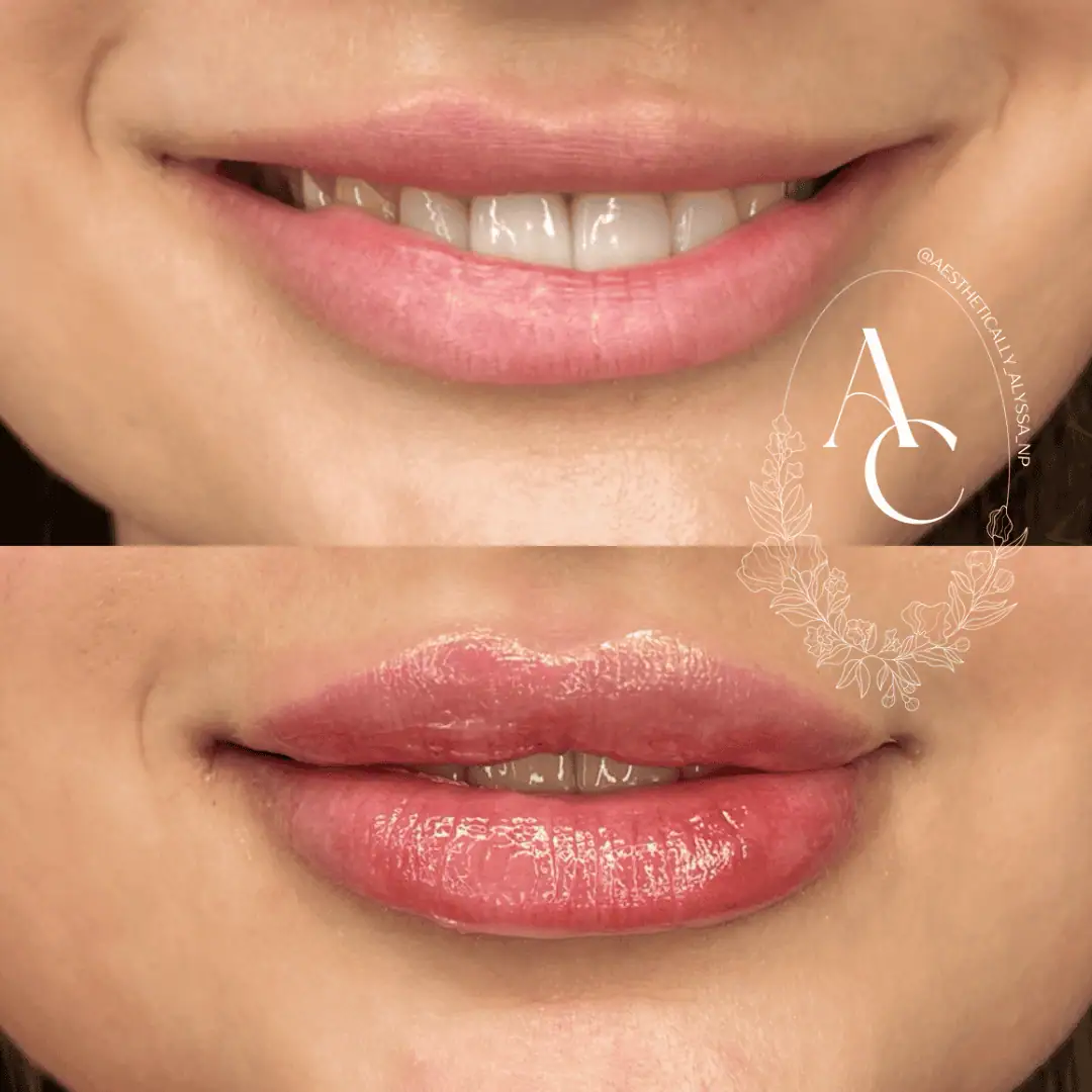 Lip Filler in New York | Timelyss Med Spa