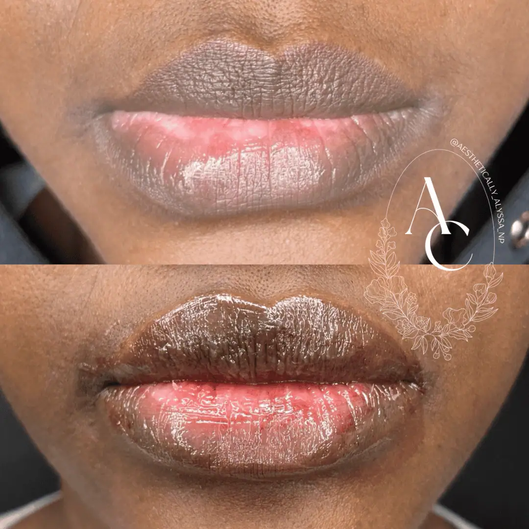 Lip Filler in New York | Timelyss Med Spa