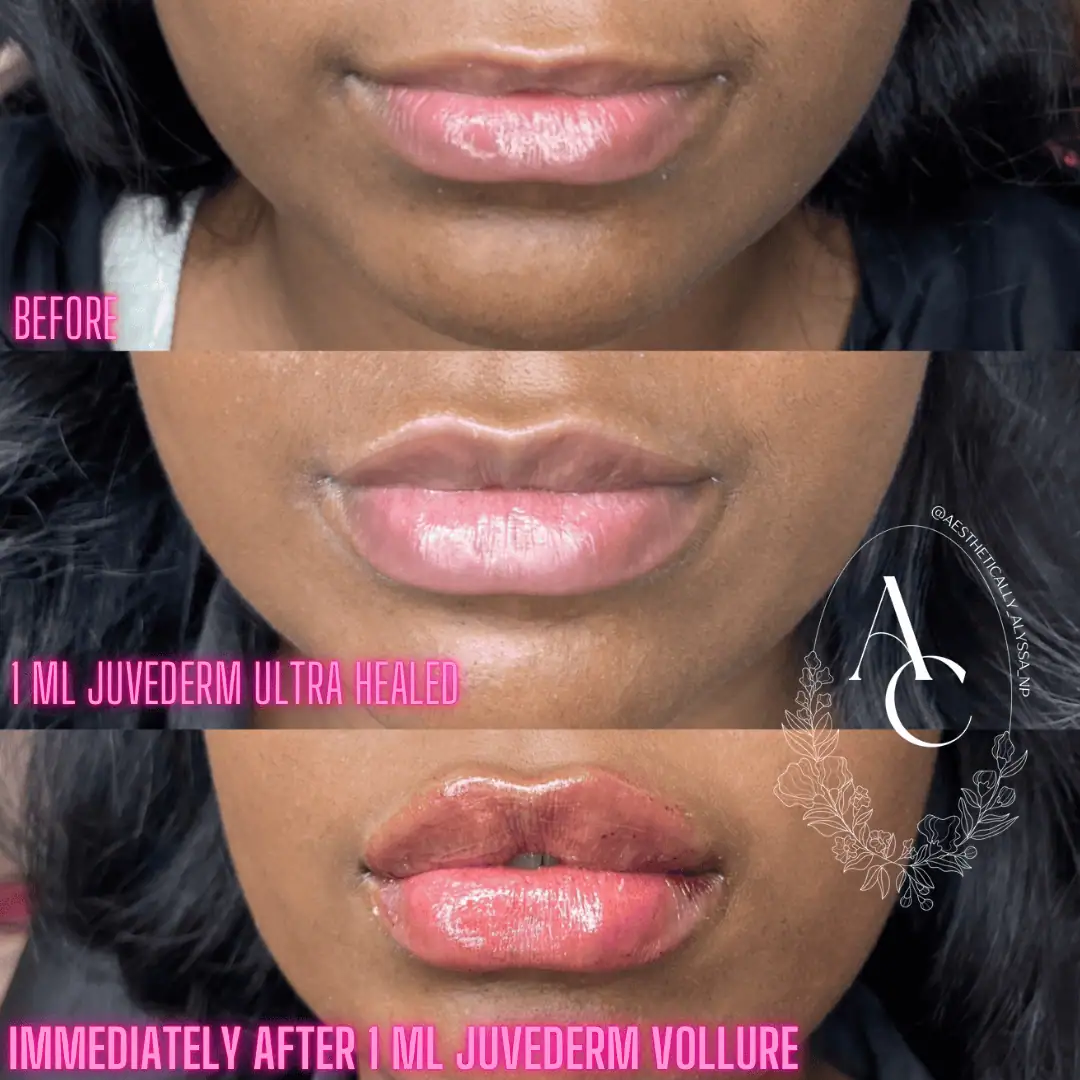 Lip Filler Services in New York by Timelyss Med Spa