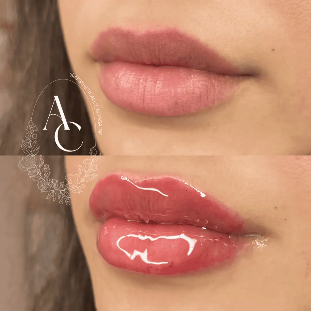 Lip Filler in New York | Timelyss Med Spa