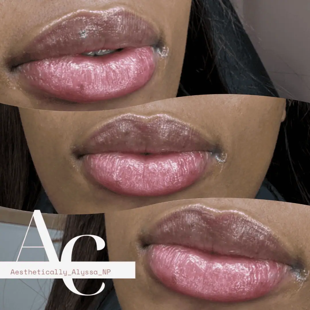 Lip Filler Services in New York by Timelyss Med Spa