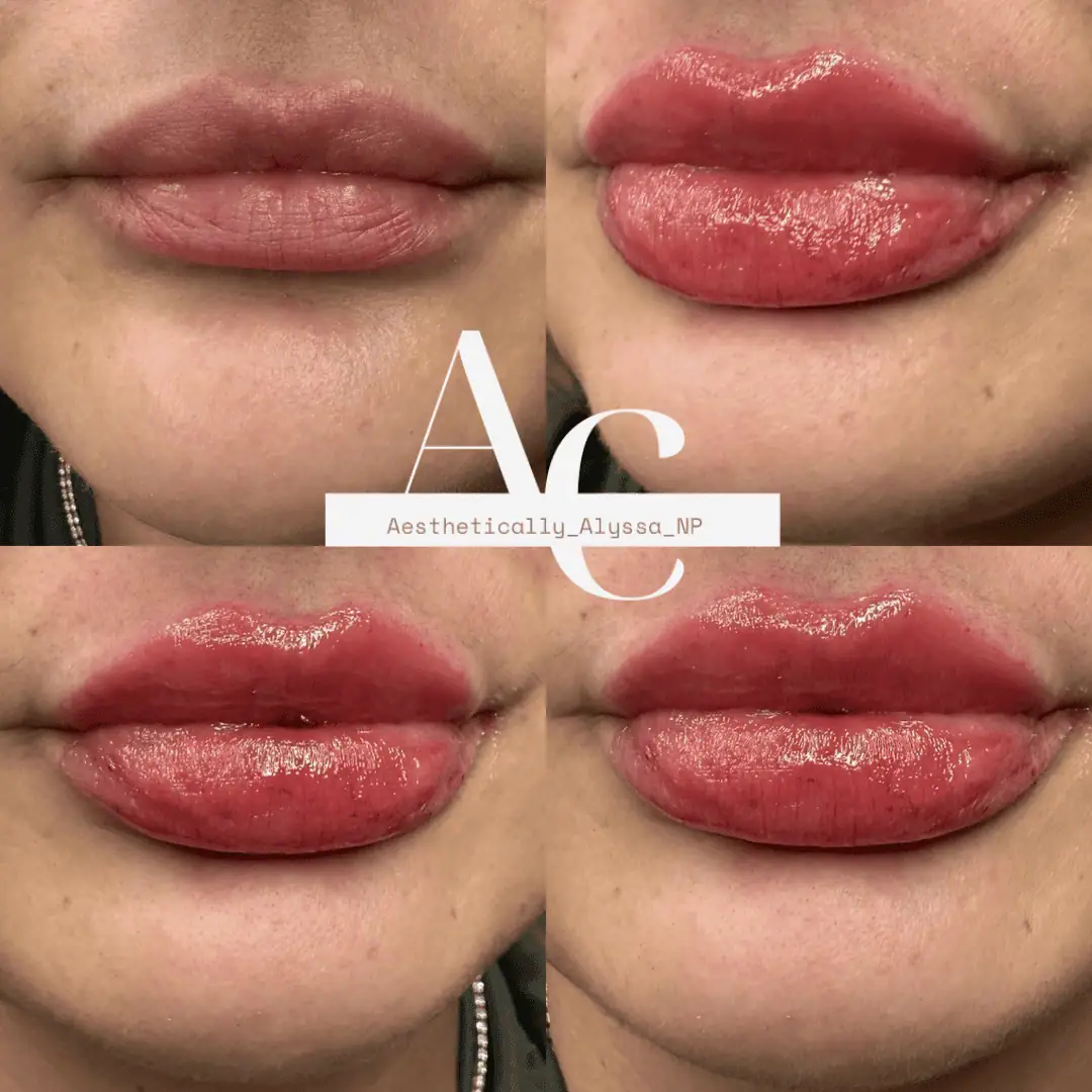 Lip Filler in New York | Timelyss Med Spa