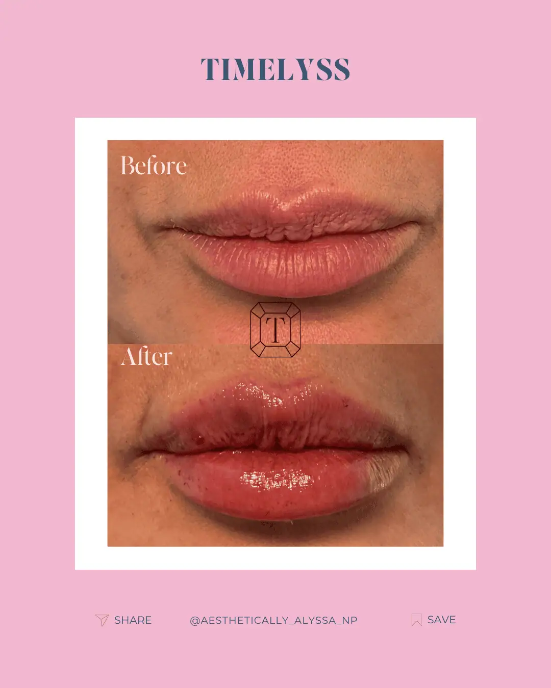 Lip Filler in New York | Timelyss Med Spa