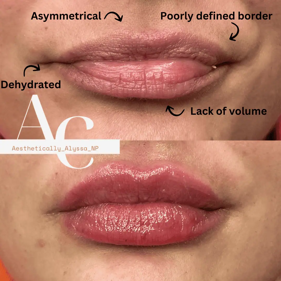 Lip Filler in New York | Timelyss Med Spa