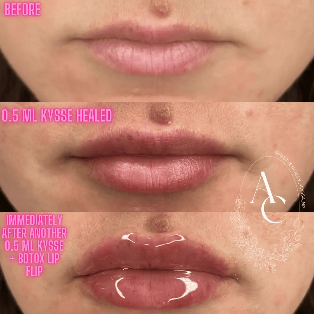 Lip Filler in New York | Timelyss Med Spa