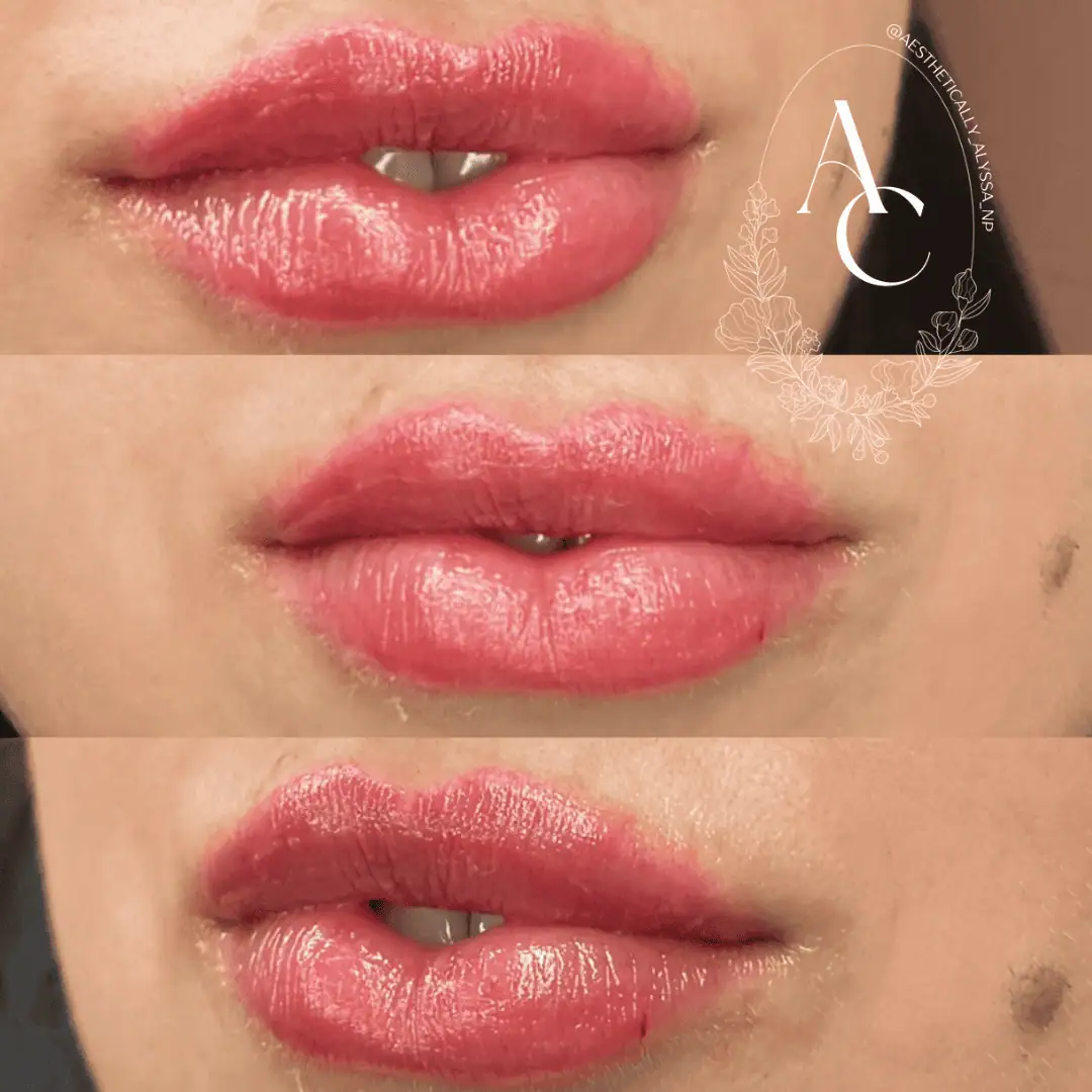 Lip Filler Services in New York by Timelyss Med Spa