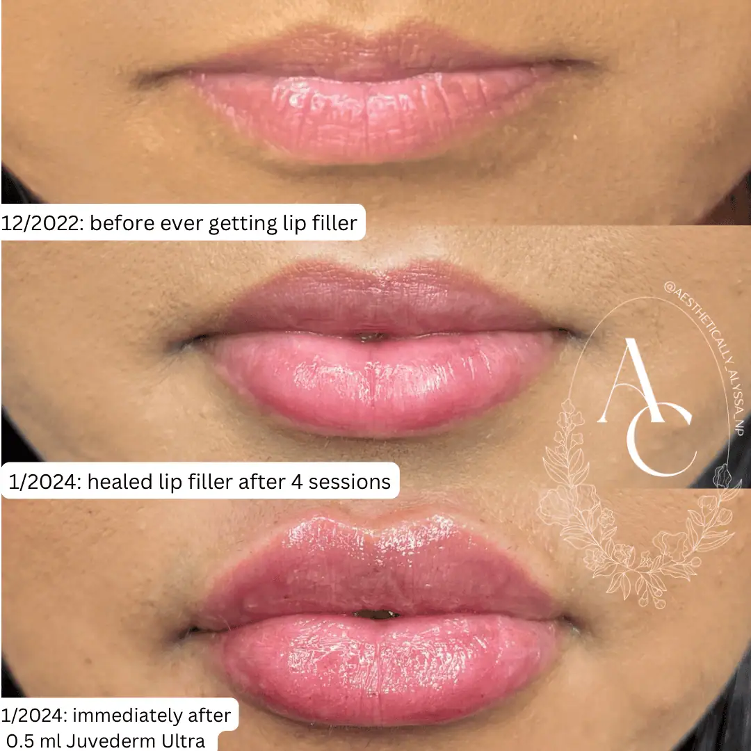 Lip Filler in New York | Timelyss Med Spa