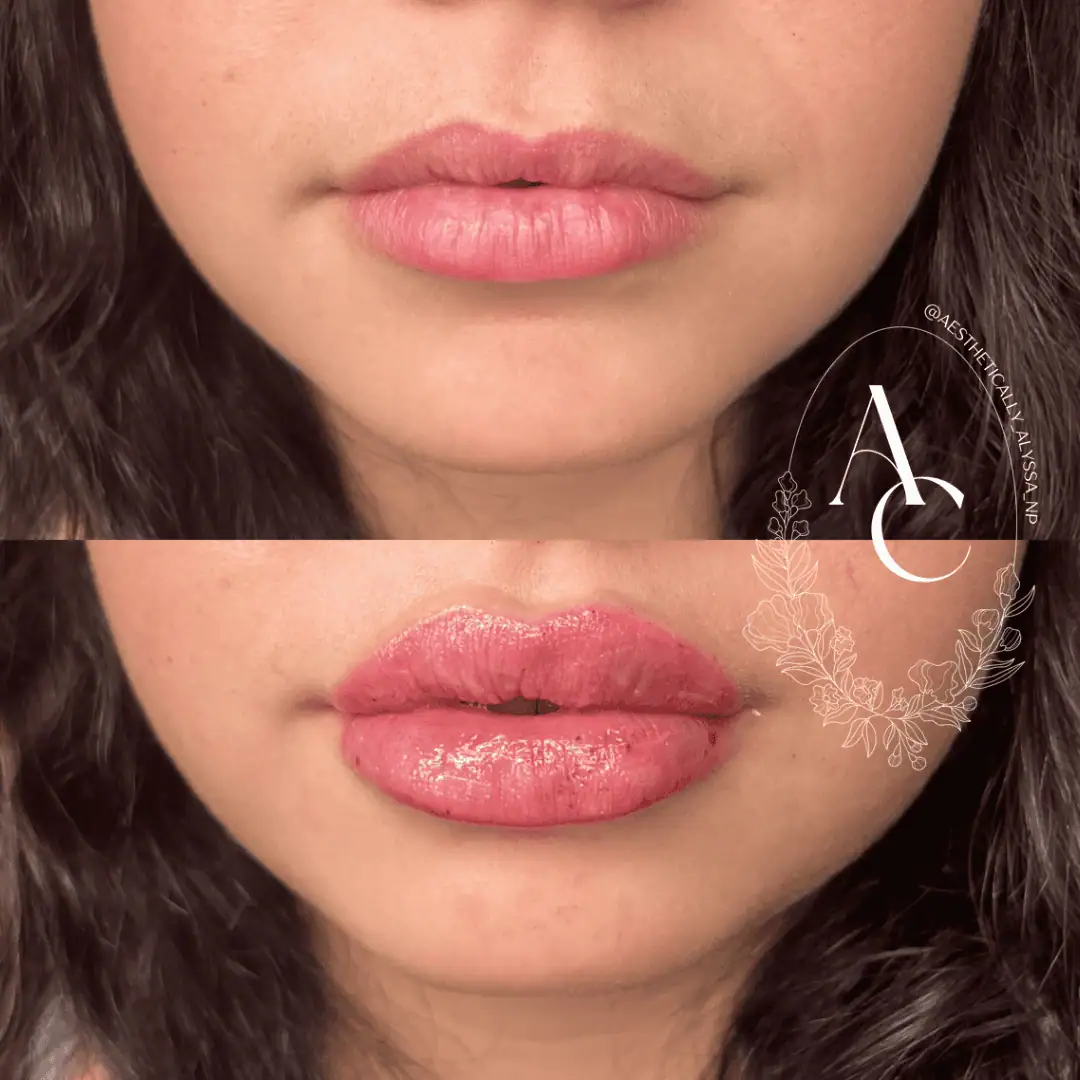 Lip Filler in New York | Timelyss Med Spa