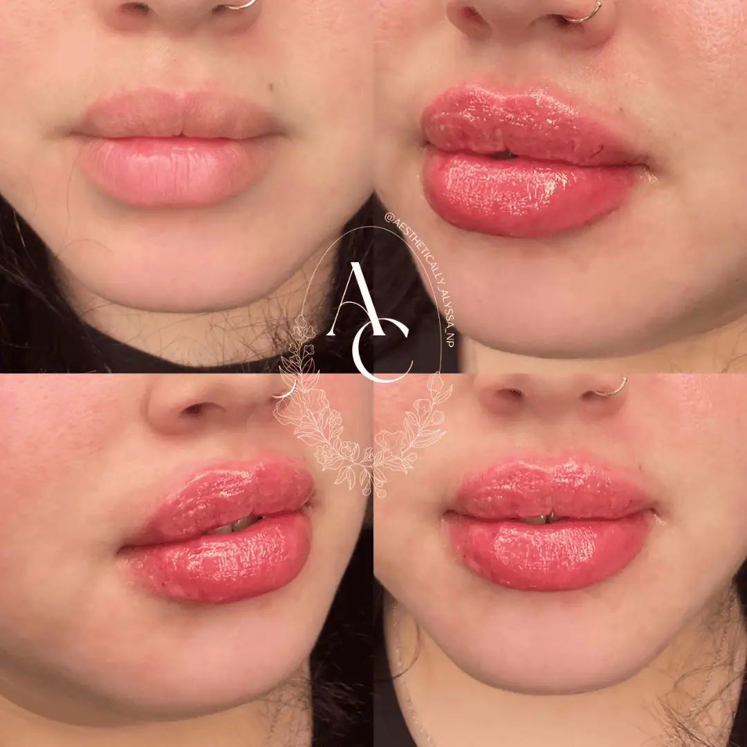 Lip Filler in New York | Timelyss Med Spa