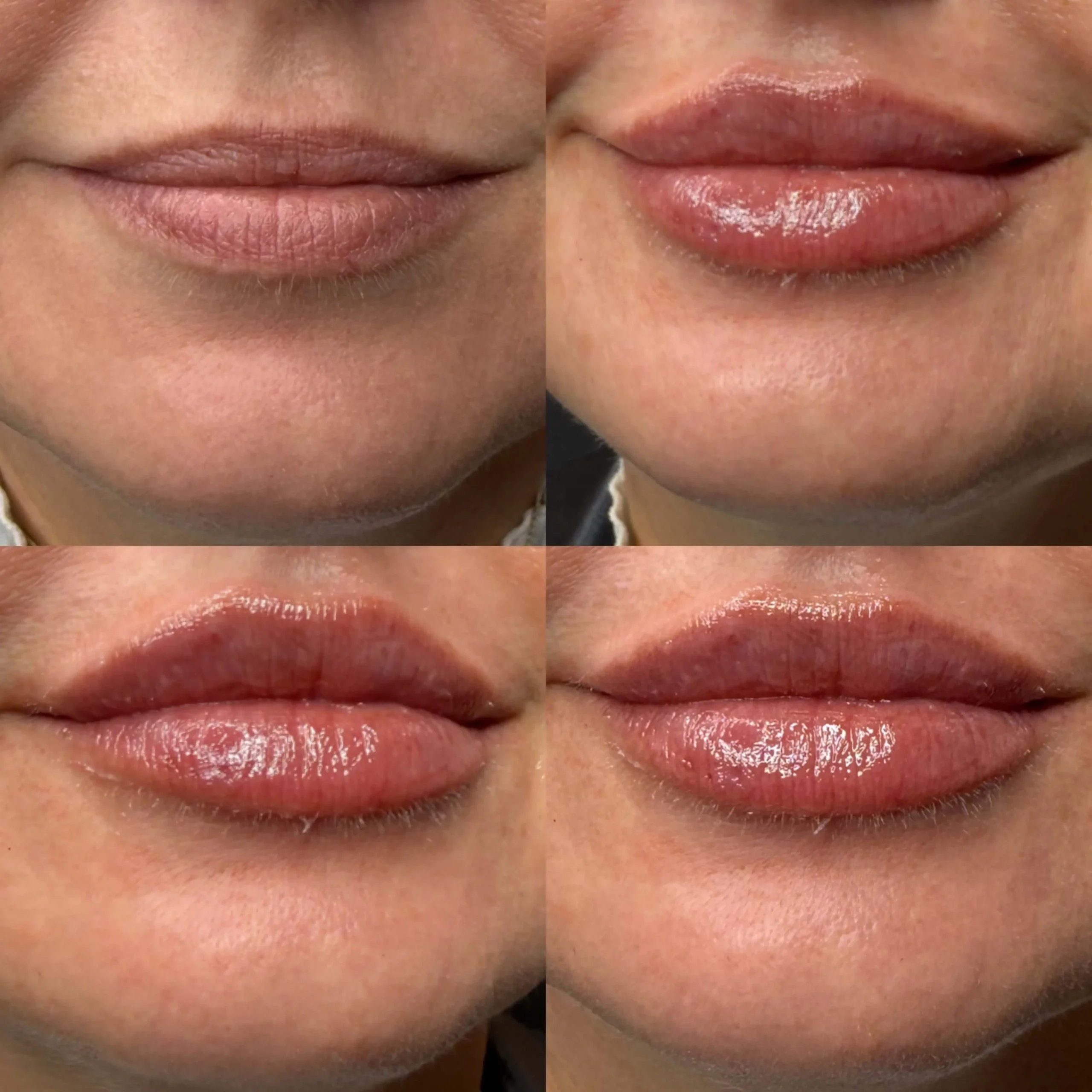 Lip Filler Services in New York by Timelyss Med Spa