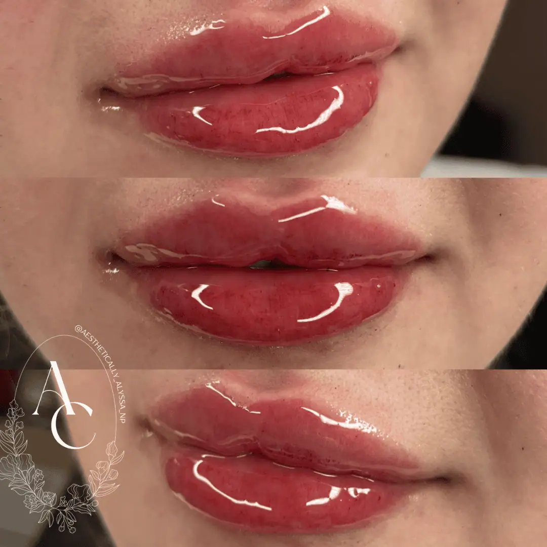 Lip Filler Services in New York by Timelyss Med Spa