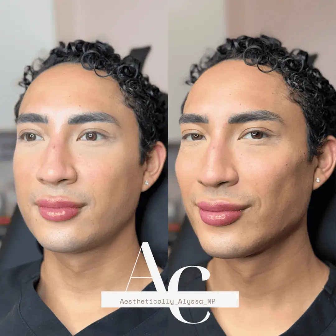 Cheek Filler in New York | Timelyss Med Spa