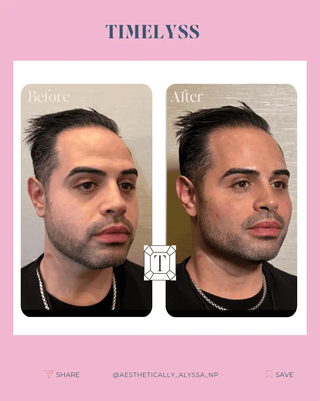 Cheek Filler in New York | Timelyss Med Spa