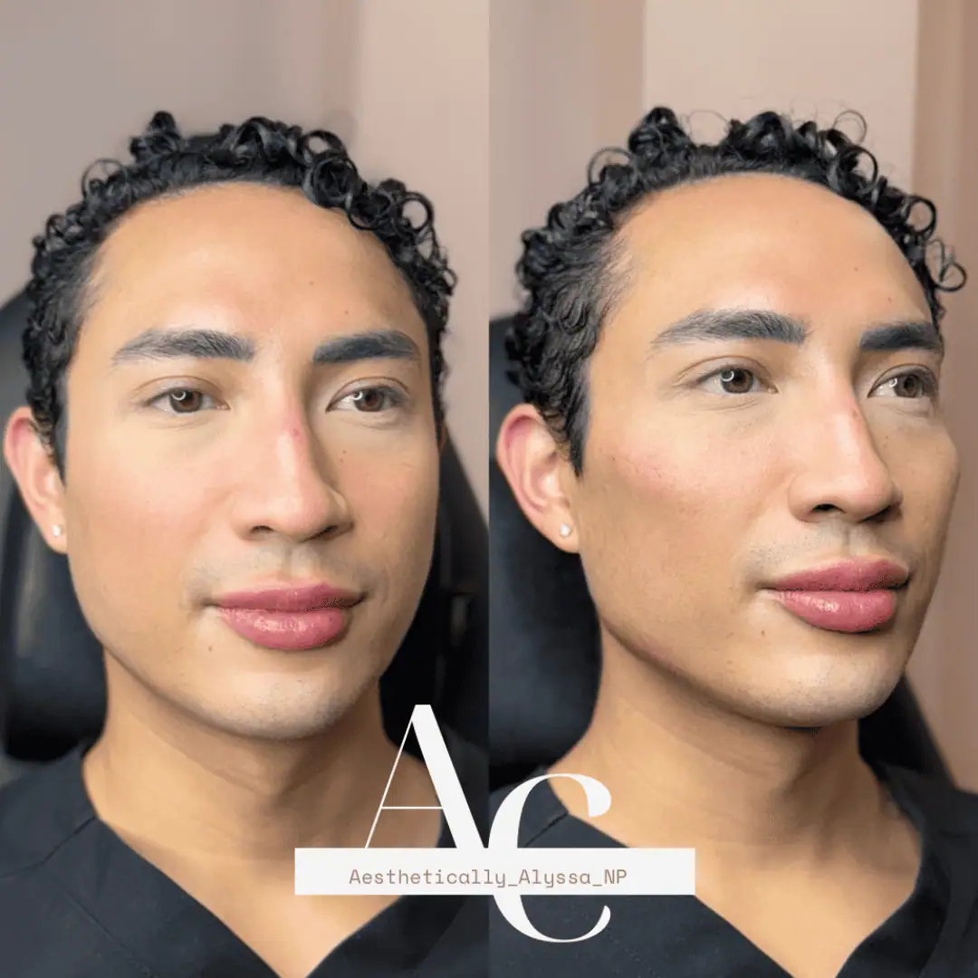 Cheek Filler in New York | Timelyss Med Spa