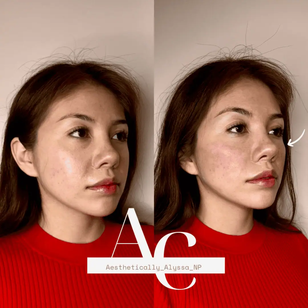 Cheek Filler in New York | Timelyss Med Spa