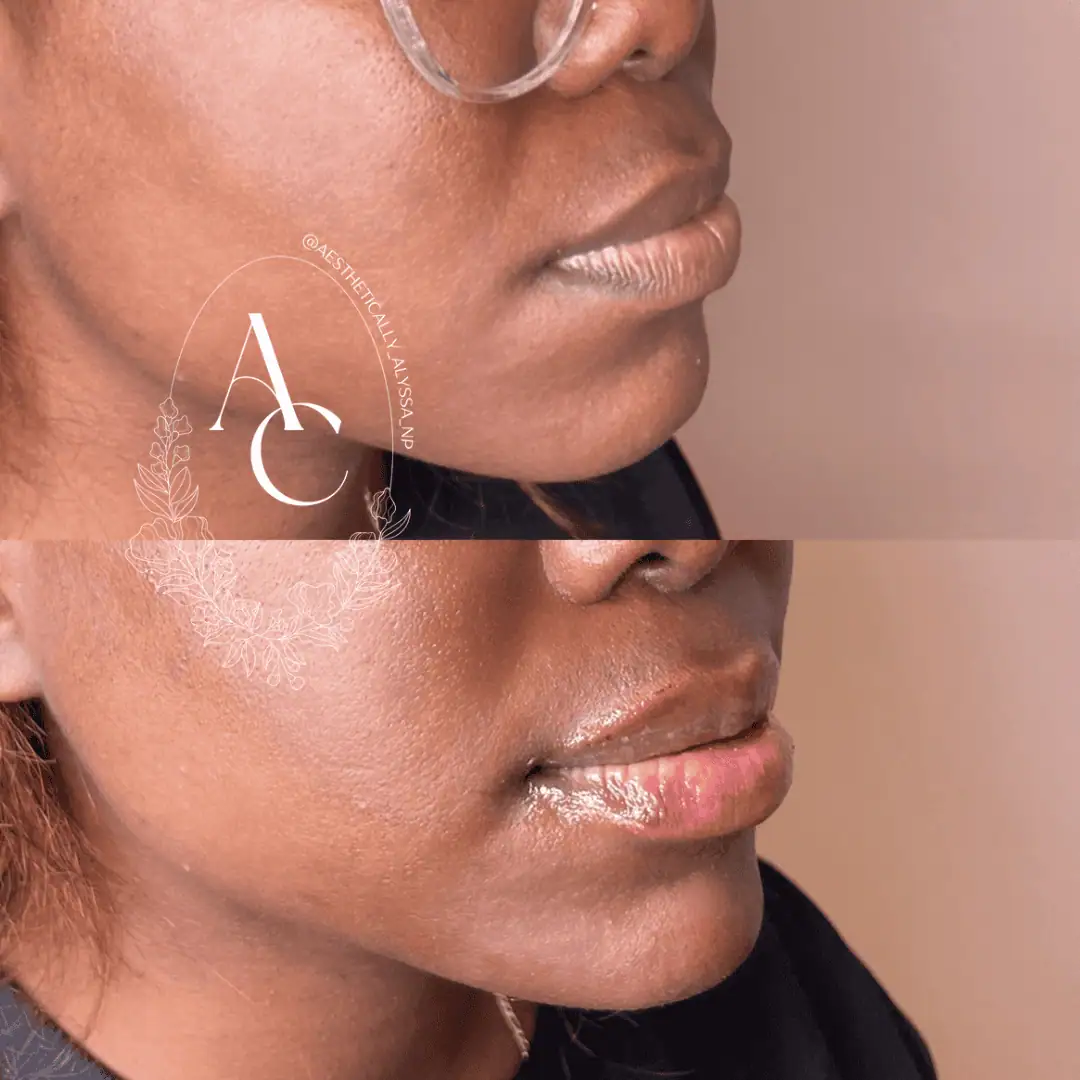 Chin Fillers in New York | Timelyss Med Spa
