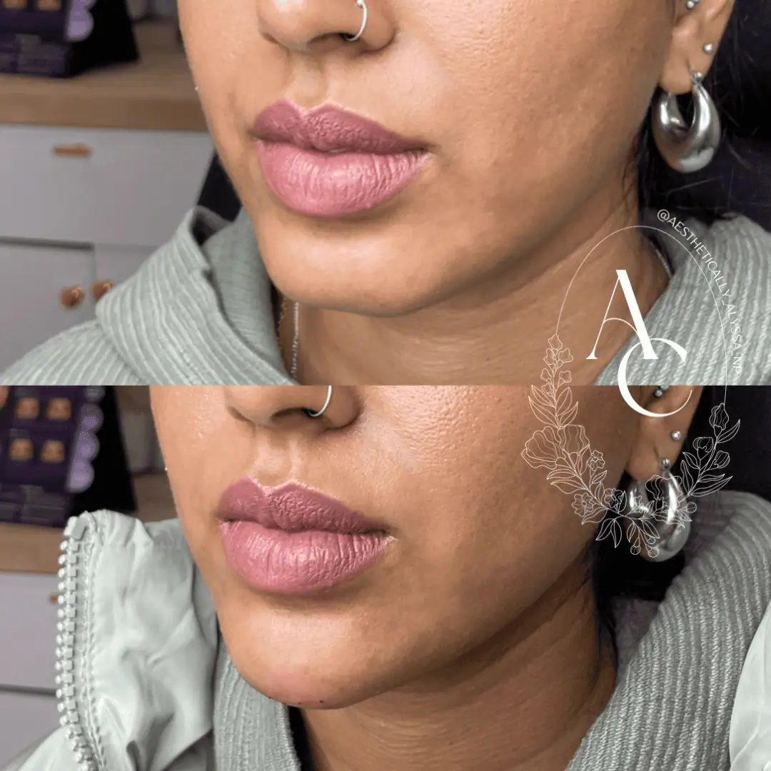 Chin Fillers in New York | Timelyss Med Spa