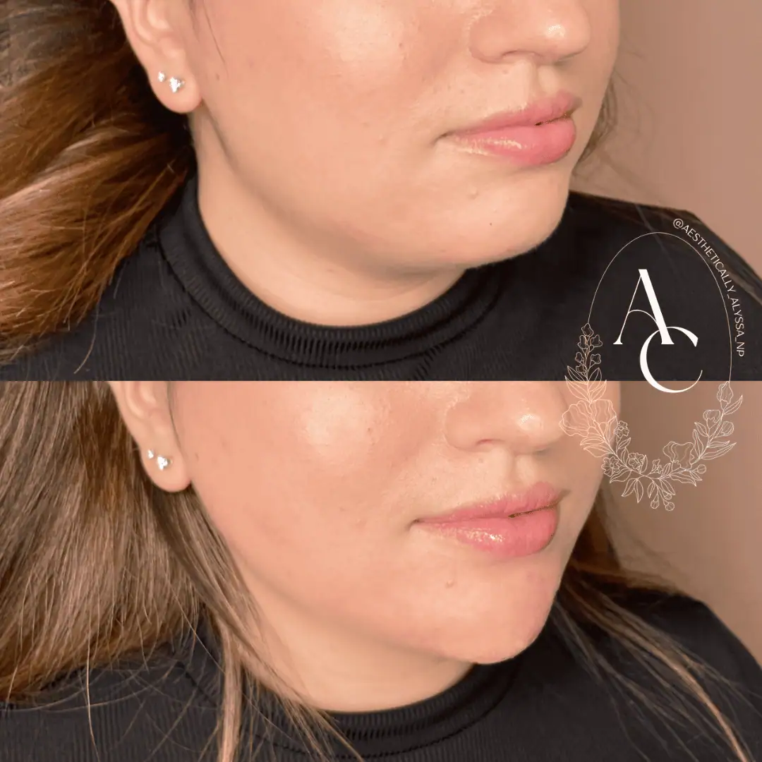 Chin Fillers in New York | Timelyss Med Spa