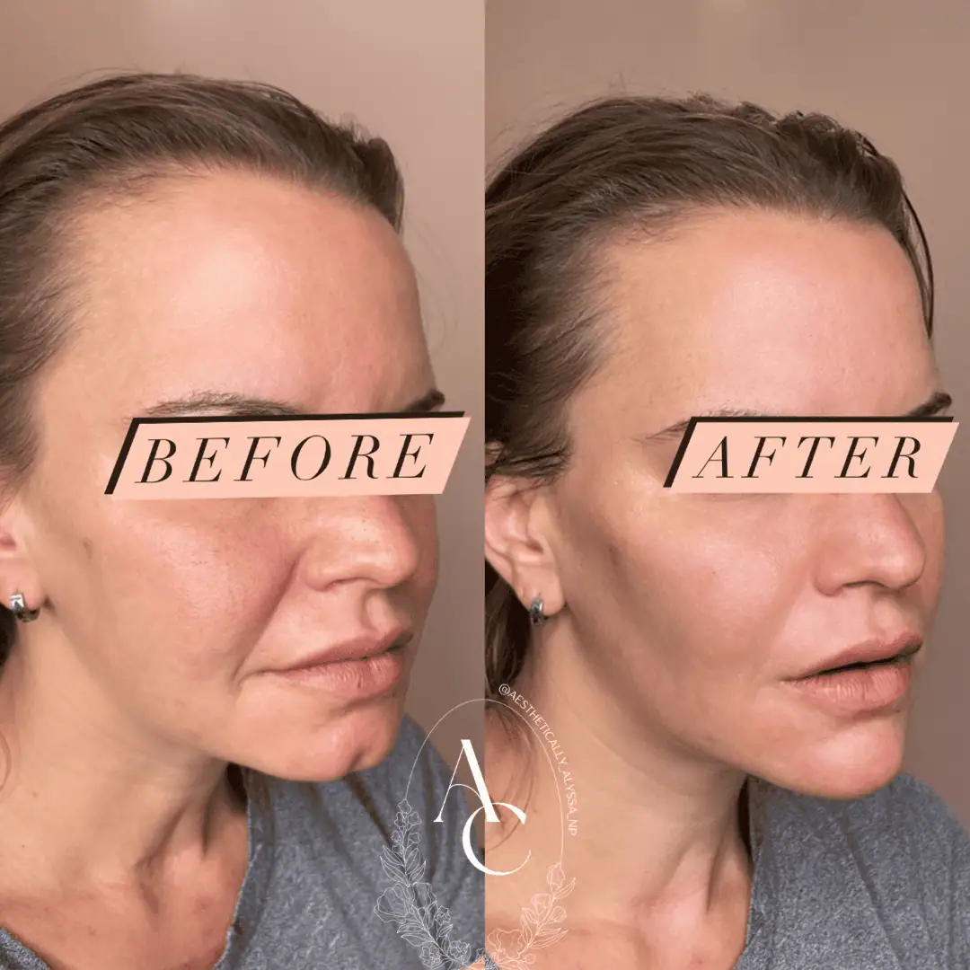 Chin Fillers in New York | Timelyss Med Spa