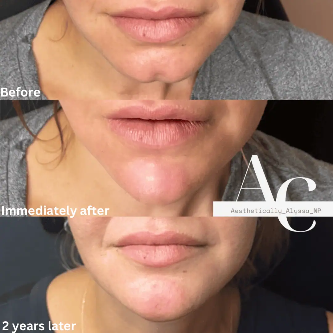 Chin Filler in New York | Timelyss Med Spa